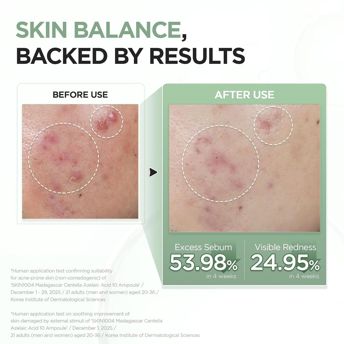 SKIN1004 Madagascar Centella Azelaic Acid 10 Ampoule (30ml)